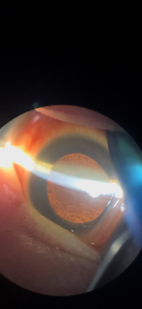 SabrinaKhalil's tweet photo. My attempt at showing you tunica vasculosa lentis (TVL) w a portable 🔬slit lamp in a premature baby in the NICU. TVL is the 🩸vascular network that supplies the 📸 lens during 🤰🏽 fetal development &amp; regresses by term.
It can be persistent, especially in pre-term babies. #ophtho https://t.co/OWmqFgQDe2
