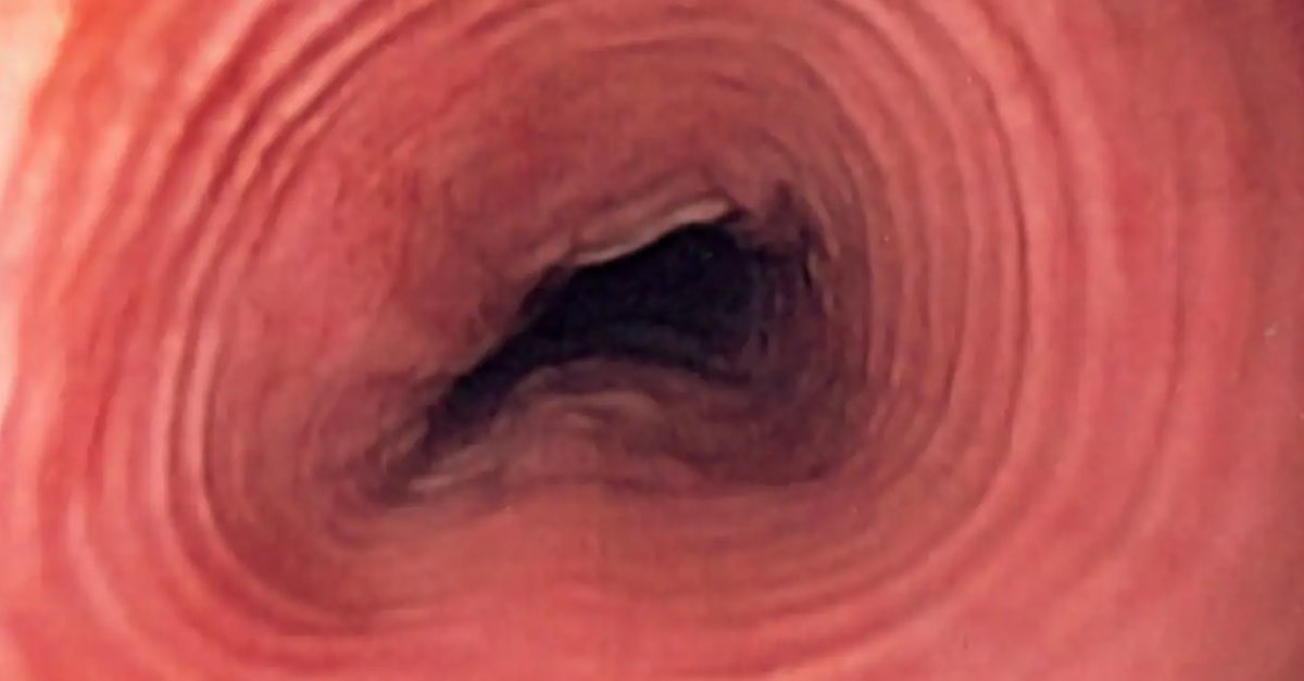 IG_pathology360's tweet photo. Trachealization of Esophagus; What does the term mean ? Explained here. It’s typically described in Eosinophilic Esophagitis. #MedEd #medstudents #pathology360 https://t.co/SjBzYqUk6e
