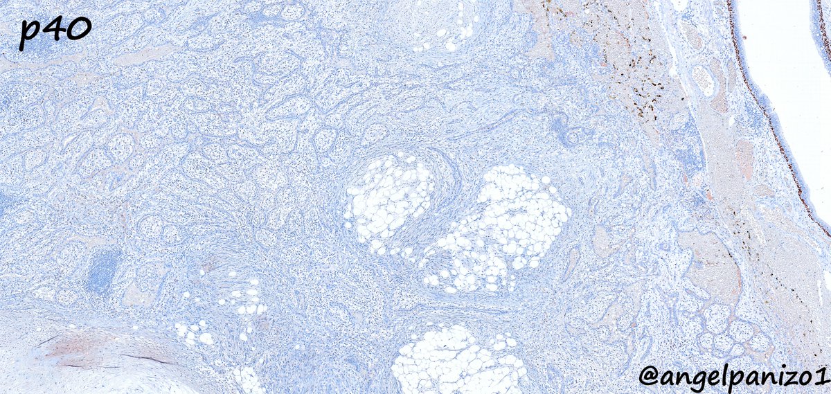 Incidental lung tumor (hamartoma & pulmonary placental transmogrification): IHC #PathTwitter  #pulmpath @smlungpathguy @SansanoValero @yro854 @natasharekhtman @mkbaine @atman_ci @Path_Matt @MdSuster