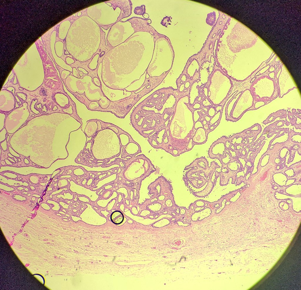 Nandini govindarajan (@nandinipath) on Twitter photo Is there a papillary cystadenoma in the breast? <a href="/ADamronMD/">Alexander Damron, MD</a> <a href="/PoloniaAntonio/">A. Polónia</a> <a href="/atman_ci/">Dr. Luca</a> <a href="/mhassanaimc/">Masood Hassan</a> <a href="/EdiBrogi/">Edi Brogi</a> <a href="/TanujaShet/">Tanuja Shet</a> please see the following tweet for more images Is there a papillary cystadenoma in the breast? <a href="/ADamronMD/">Alexander Damron, MD</a> <a href="/PoloniaAntonio/">A. Polónia</a> <a href="/atman_ci/">Dr. Luca</a> <a href="/mhassanaimc/">Masood Hassan</a> <a href="/EdiBrogi/">Edi Brogi</a> <a href="/TanujaShet/">Tanuja Shet</a> please see the following tweet for more images