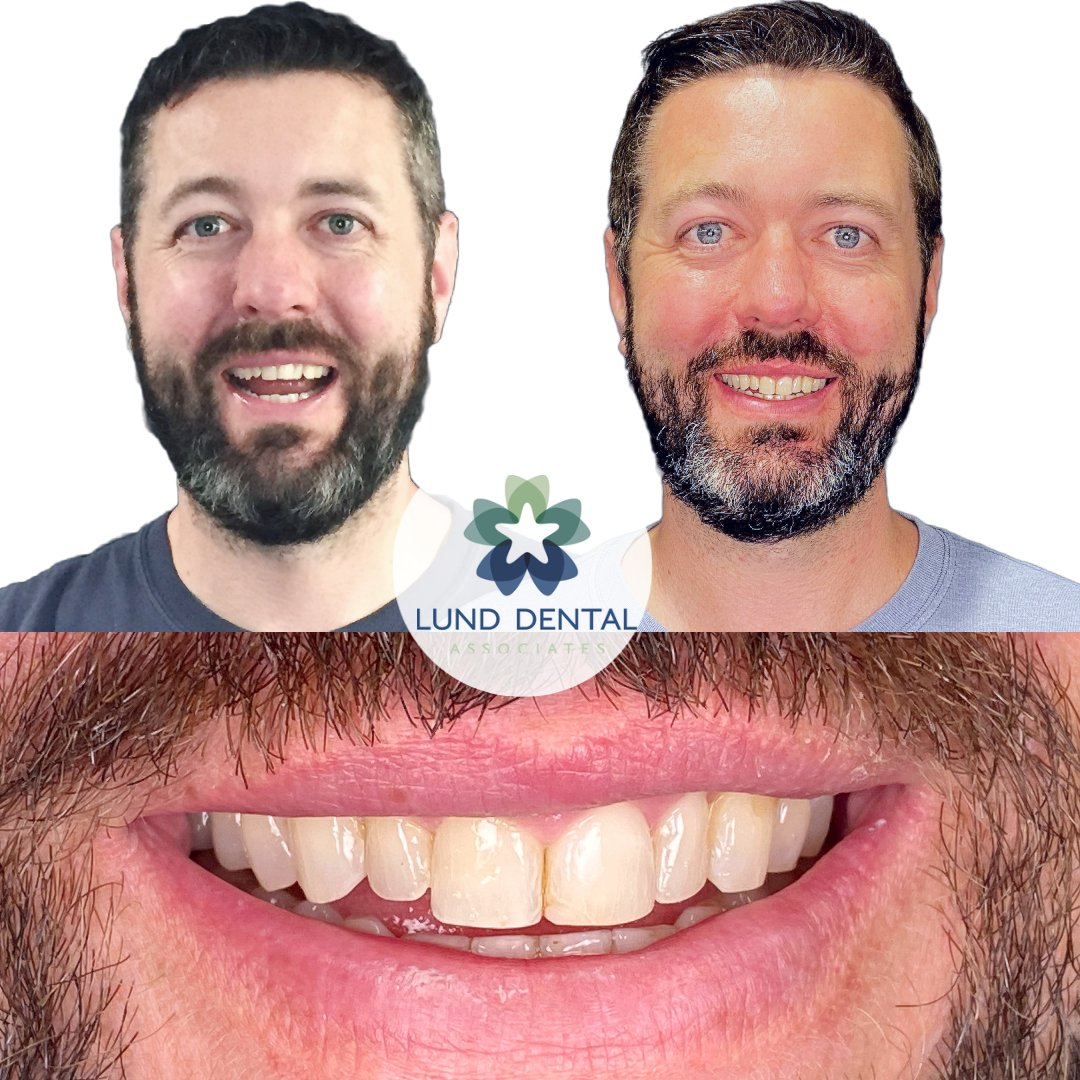 When you're ready for a smile upgrade, Lund Dental is the place and Invisalign is the tool.  Neil trusted the process and refreshed his smile.  
#healthybite #smiletransformation  #invisalignsmile #invisalignjourney #invisalign #itero #dentist #dental #stonehamma  #bestdentist