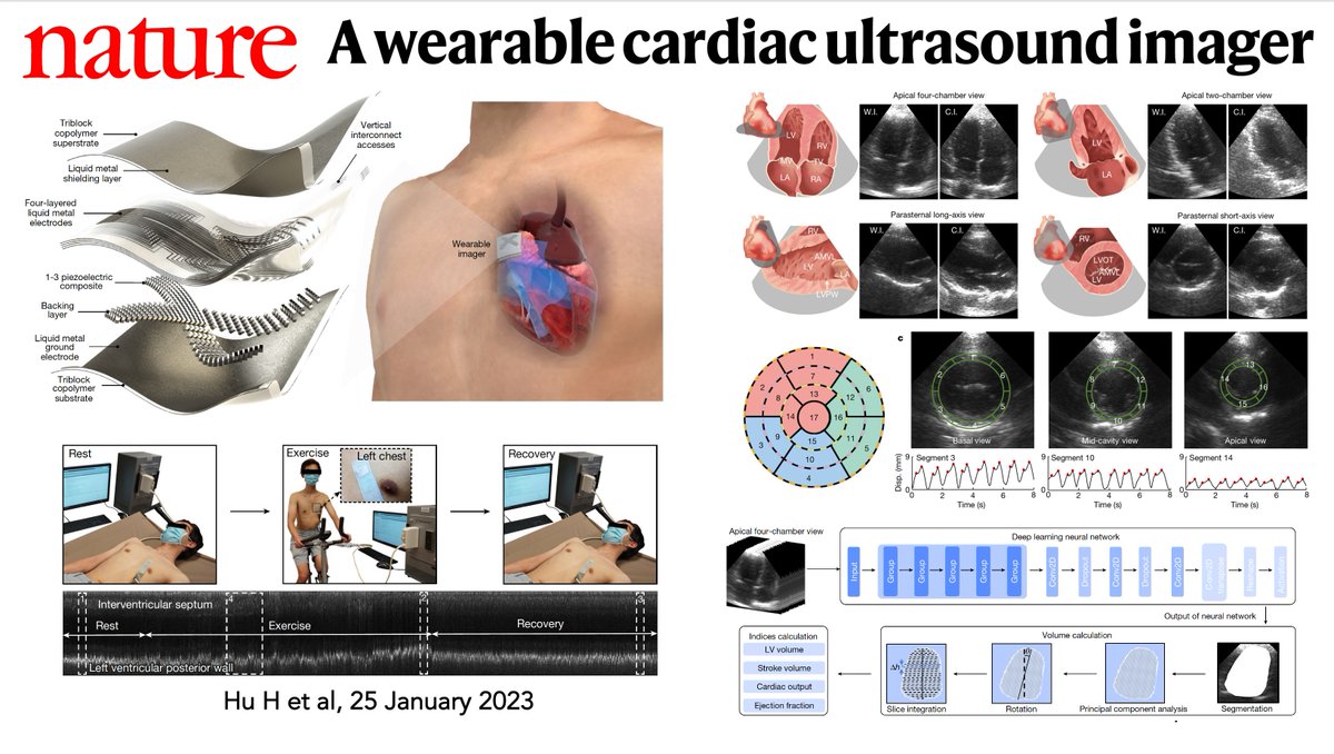 Just published <a href="/Nature/">nature</a>
Impressive. A wearable patch that acquires continuous, real-time ultrasound images of the heart at rest, on the go, and during exercise (echocardiograms) with automated processing 
nature.com/articles/s4158…