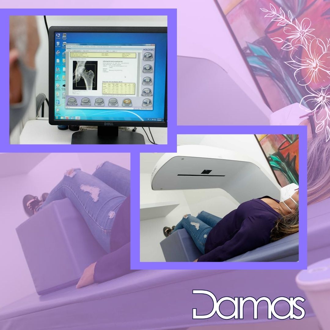 Para diagnosticar la #osteoporosis y evaluar su riesgo de sufrir #fracturas, y determinar si usted necesita un tratamiento, su médico probablemente ordenará una #densitometría ósea. 
Solicita siempre estudios de calidad, en #Damas contamos con el mejor equipo de especialistas.