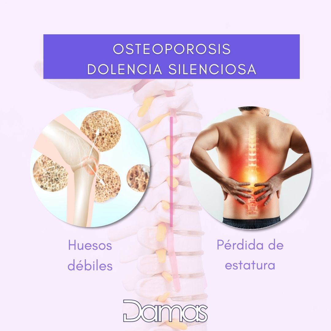 A veces la #osteoporosis puede desarrollarse sin síntomas ni dolor, como si fuese una enfermedad que no existe y de la que nadie se queja, y no se manifiesta hasta que los #huesos son tan débiles que un golpe o una caída causa una #fractura o el derrumbe de una vértebra.

#DAMAS