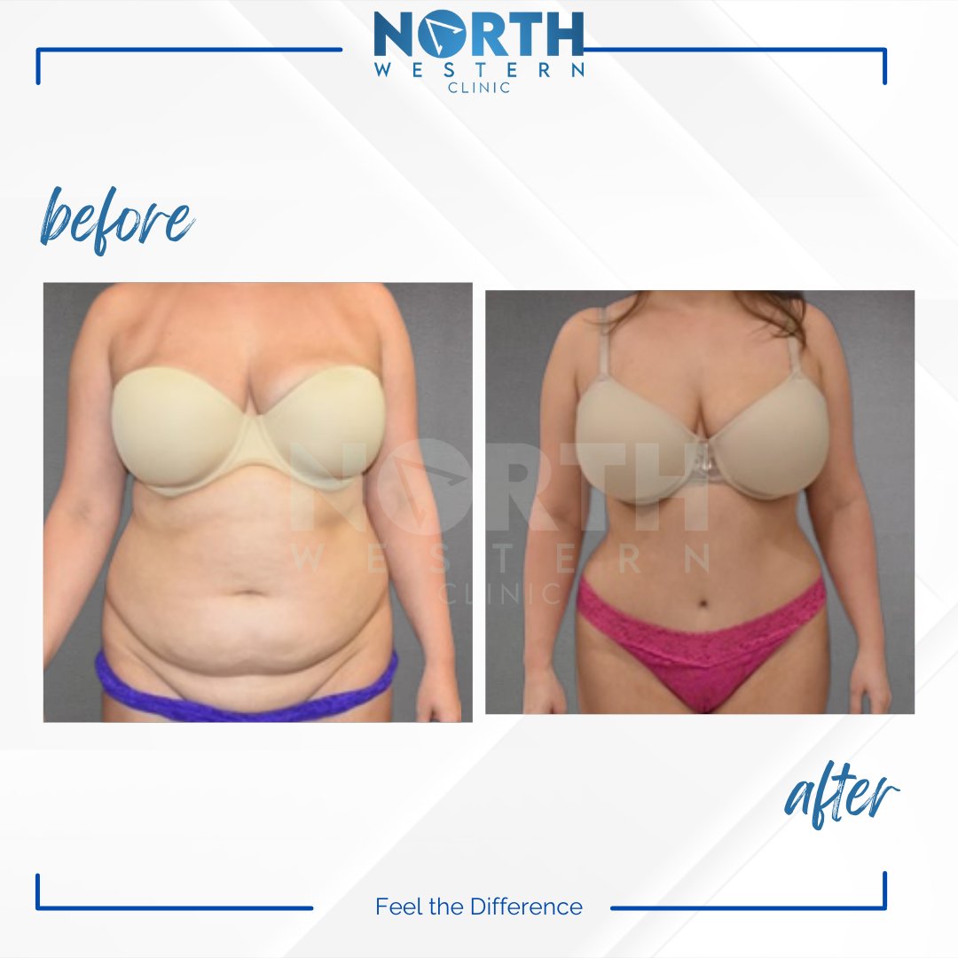 NorthWesternTR's tweet photo. Just wanted to share the amazing results of our patient's tummy tuck surgery! The team at North Western and Dr. Tolga Aksan worked together to give this patient the body she's always wanted. #tummytuck #plasticsurgery #beforeandafter https://t.co/P1TIiJkOAh
