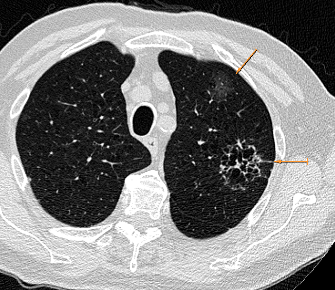 DulcichGonzalo's tweet photo. M80 smoker.
Two suspicious nodules of malignancy (ADK) one of them with a cystic aspect.
Surgery was not performed due to age.
#radiology #radtwitter #lungcancer 
@TLHM_MD @marcosmestas https://t.co/lwbprfTi5c