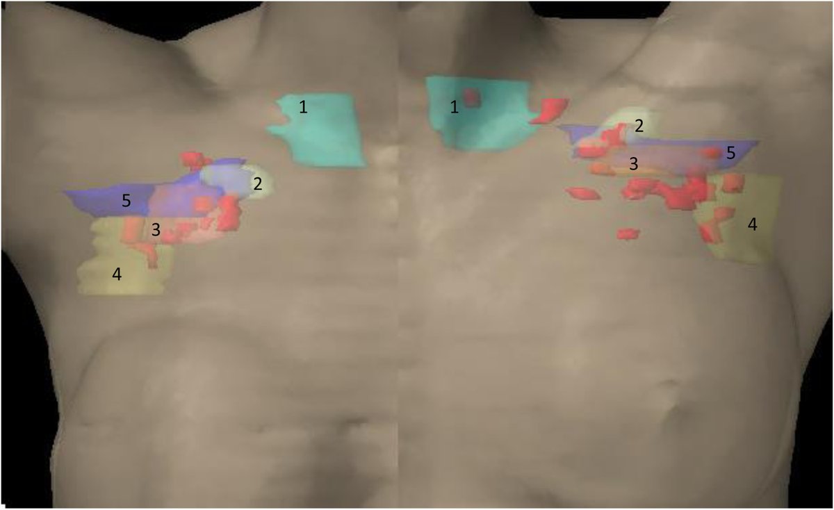 ASTRO (@astro_org) on Twitter photo In patients with breast cancer and advanced nodal disease, the majority of failures were distant w/ no isolated LRFs. Failures were highest in the IMN + ax/SCV boost group. <a href="/juhi_purswani/">Juhi M. Purswani, MD</a> <a href="/NaamitGerber/">Naamit Kurshan Gerber</a> bit.ly/3OI0GIt In patients with breast cancer and advanced nodal disease, the majority of failures were distant w/ no isolated LRFs. Failures were highest in the IMN + ax/SCV boost group. <a href="/juhi_purswani/">Juhi M. Purswani, MD</a> <a href="/NaamitGerber/">Naamit Kurshan Gerber</a> bit.ly/3OI0GIt