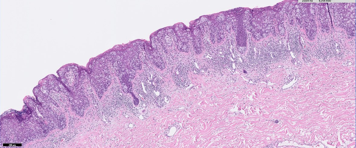 OhioStatePath's tweet photo. #Pathnewbies #pathresidents
Groin biopsy from a 70 year old male.
๐What is the most likely diagnosis/differential diagnosis?
๐What IHC would you get to confirm you diagnosis? #PathTwitter https://t.co/mZRz7U1T1h