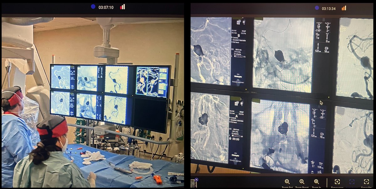Gabriel Broocks (@broocksgabriel) on Twitter photo Spontaneous late night proctor session with <a href="/AndreKemmling/">André Kemmling</a>: Acute SAH with 12 mm basilar aneurysms between AICA and vertebral arteries. Stent (Pegasus HPC) + Flow Diverter (p64 HPC) via left V4, transradial coil embolization via right V4, <a href="/uta_hanning/">Uta Hanning</a> <a href="/EYMINT_ESMINT/">EYMINT</a> <a href="/Fie0815/">Jens Fiehler</a> Spontaneous late night proctor session with <a href="/AndreKemmling/">André Kemmling</a>: Acute SAH with 12 mm basilar aneurysms between AICA and vertebral arteries. Stent (Pegasus HPC) + Flow Diverter (p64 HPC) via left V4, transradial coil embolization via right V4, <a href="/uta_hanning/">Uta Hanning</a> <a href="/EYMINT_ESMINT/">EYMINT</a> <a href="/Fie0815/">Jens Fiehler</a>