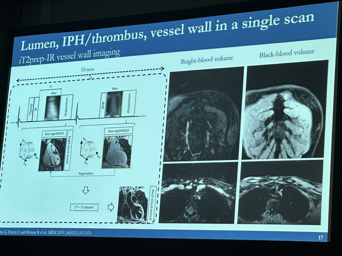 Anu Dodeja, MD, FACC (@anudodejamd) on Twitter photo Watch out #yesCCT ! check out these beautiful non contrast MRA coronary images 🤯 #whyCMR #SCMR23 <a href="/SCMRorg/">Society for Cardiovascular Magnetic Resonance</a> <a href="/scmrchd/">@SCMRchd</a> <a href="/purviparwani/">Dr. Purvi Parwani</a> <a href="/DrJenniferCo_Vu/">Jennifer Co-Vu, MD, FACC, FAAP, FASE</a> <a href="/PushpaShivaram/">Pushpa Shivaram MD FACC</a> <a href="/Jason_N_Johnson/">Jason N. Johnson, MD MHS</a> <a href="/RayRcnita/">Nita Ray Chaudhuri, MD, FACC, FSCMR</a> <a href="/CMRdoc/">Brian Fonseca</a> Watch out #yesCCT ! check out these beautiful non contrast MRA coronary images 🤯 #whyCMR #SCMR23 <a href="/SCMRorg/">Society for Cardiovascular Magnetic Resonance</a> <a href="/scmrchd/">@SCMRchd</a> <a href="/purviparwani/">Dr. Purvi Parwani</a> <a href="/DrJenniferCo_Vu/">Jennifer Co-Vu, MD, FACC, FAAP, FASE</a> <a href="/PushpaShivaram/">Pushpa Shivaram MD FACC</a> <a href="/Jason_N_Johnson/">Jason N. Johnson, MD MHS</a> <a href="/RayRcnita/">Nita Ray Chaudhuri, MD, FACC, FSCMR</a> <a href="/CMRdoc/">Brian Fonseca</a>