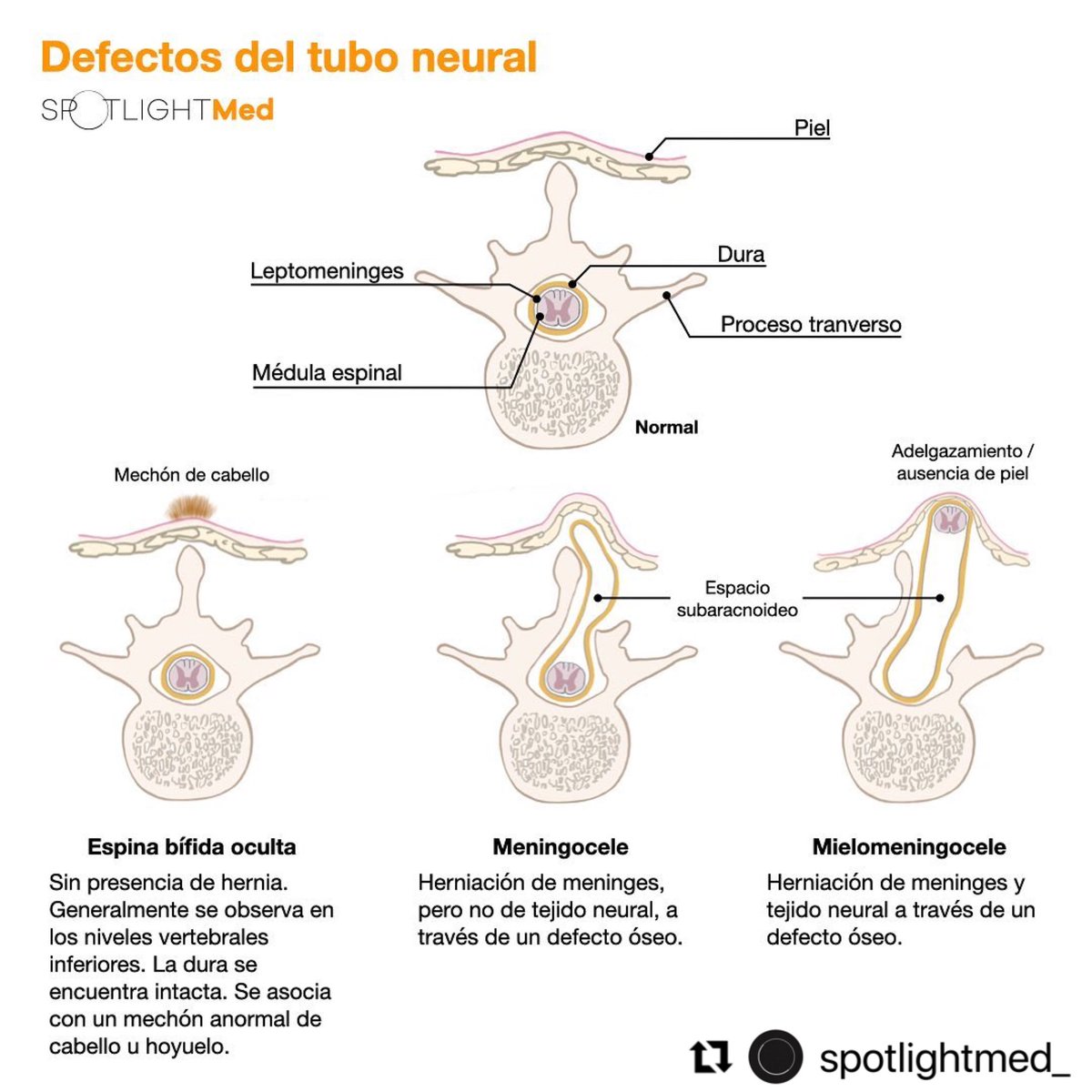 Defectos del tubo neural 🤓🧠🤰🏻 #spotlightmed #spotlight #medcoach #flashcards #neuro #repaso #medlife #medstudent #med #cerebro #pediatria #enarm2023 #enarm #mip #mpss