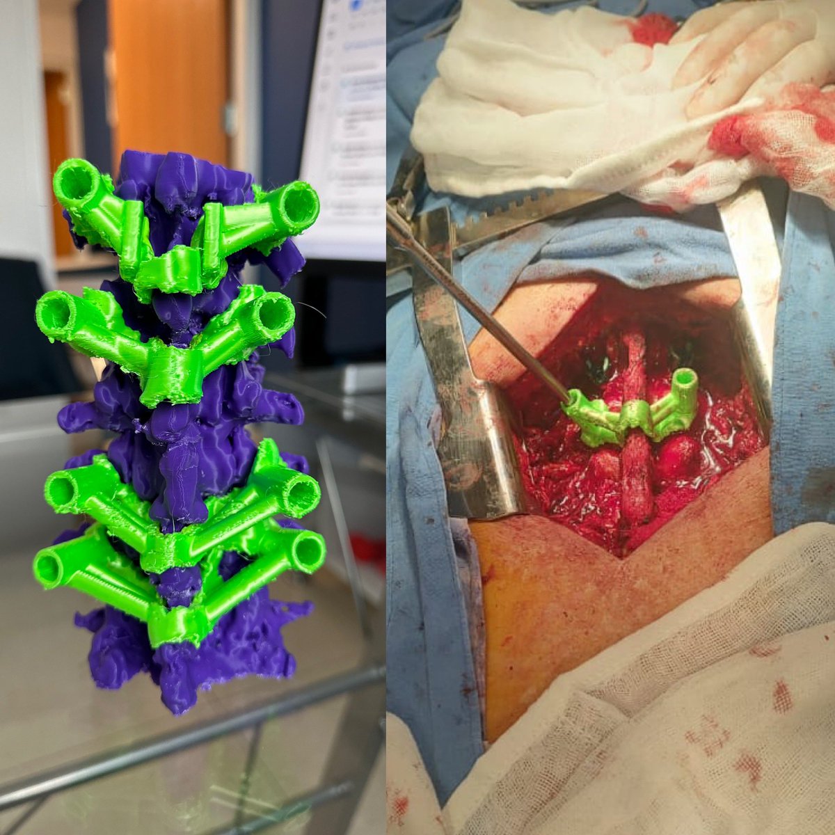 OrtoDrJuarez's tweet photo. Fractura de L2 , biomodelo impreso 3D de T12 a L4 , creación de guías específicas para colocación de tornillos transpediculares con TAC de control postquirugica #3dcot #spine #orthotwitter #3dprint #fracture https://t.co/mpfIISo1hR