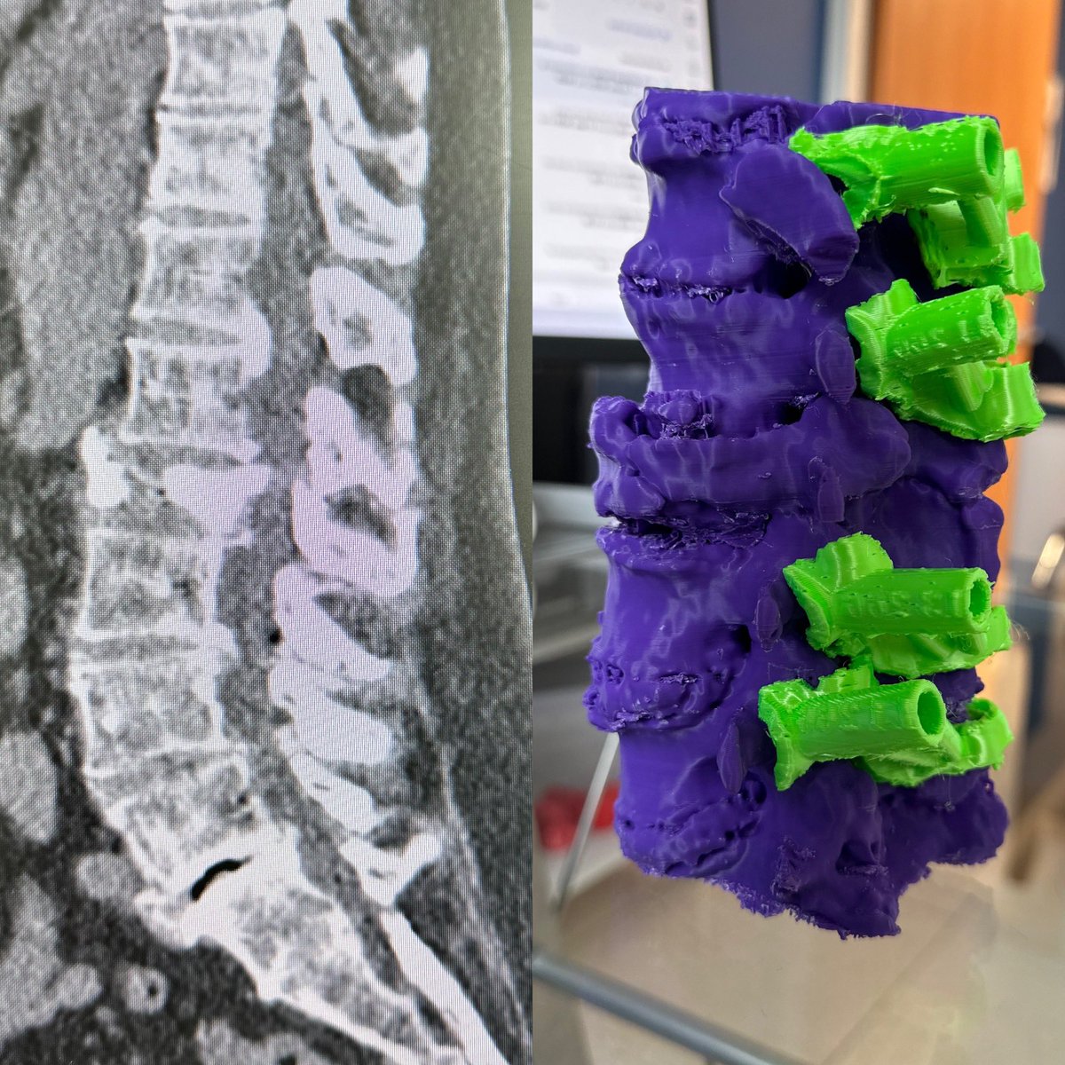 OrtoDrJuarez's tweet photo. Fractura de L2 , biomodelo impreso 3D de T12 a L4 , creación de guías específicas para colocación de tornillos transpediculares con TAC de control postquirugica #3dcot #spine #orthotwitter #3dprint #fracture https://t.co/mpfIISo1hR