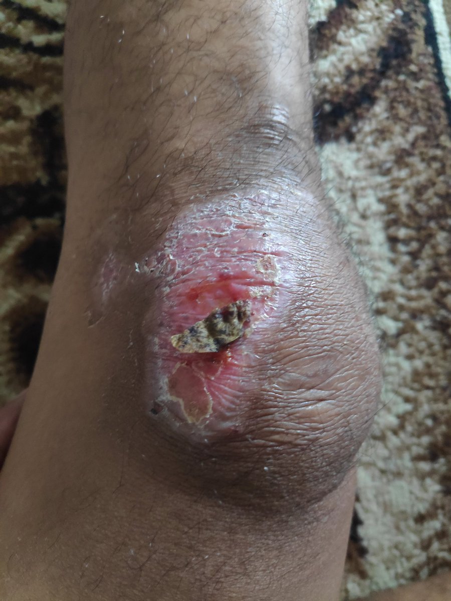 Lama juga ini luka keringnya, udah hari ke 17