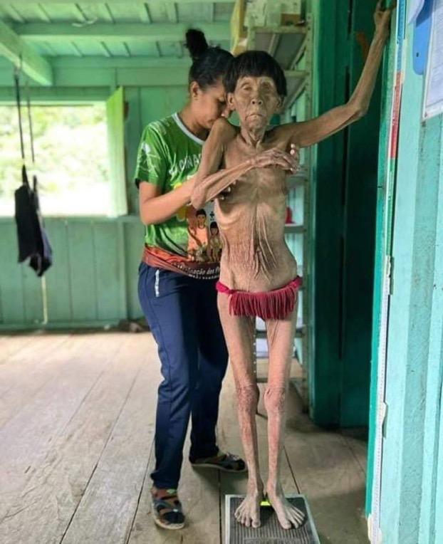 willian19661's tweet photo. Indigenas Yanomamis habitantes de  la frontera venezolana con Brasil, huyen del hambre y desplazados por las compañias venezolanas explotadoras de oro, hoy fueron localizados en la selva del Roraima- Brasil muriendo de hambre y contaminados con mercurio,esto es un gran GENOCIDIO. https://t.co/LuAszQ4omc