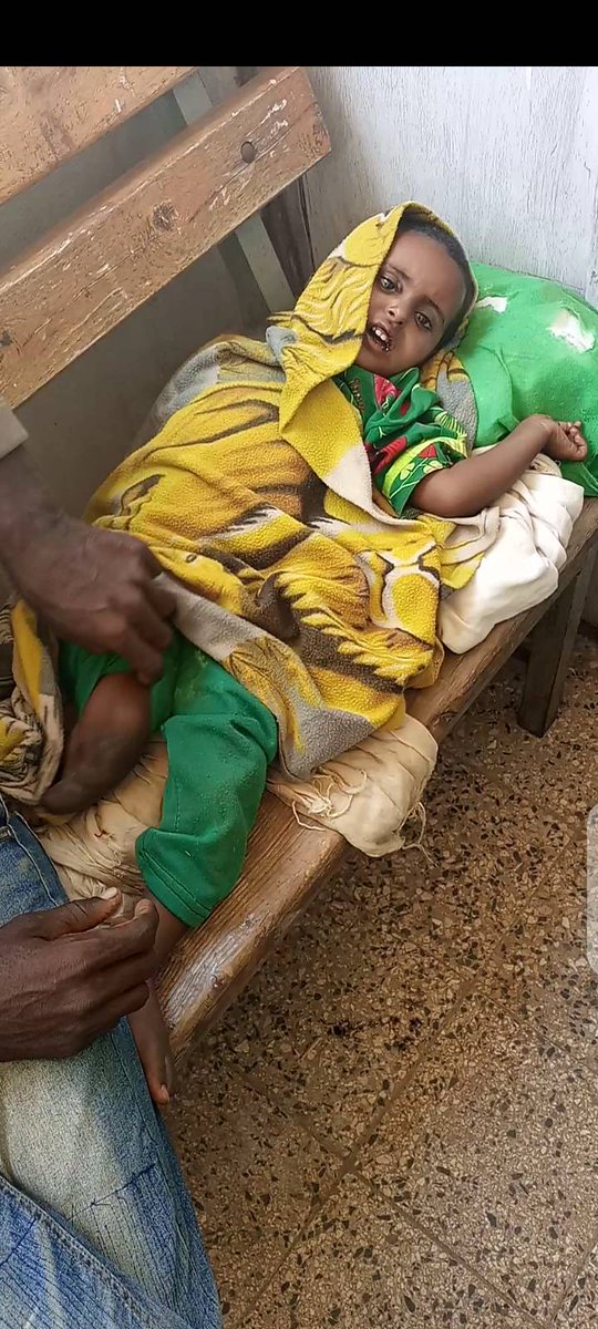 GebremeskelGeb's tweet photo. Name: Birhanu, female, 3 yrs
Place of birth: near Endabaguna, NW #Tigray
Injury: lost a limb b/se of the invading forces
Health situation: Typhoid fever
Status: died on Jan 25, 2023, due to the absence of medical treatment.
#TigrayGenocide 
@unicefchief @DrTedros @WHO @UNICEF https://t.co/blnnfexZ03