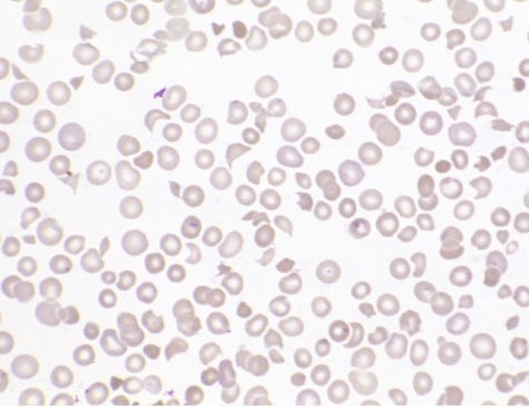 Patient day 20 after BMT

Blood pressure suddenly ☝️
Platelets👇again after engraftment😔
Creatinine ☝️

You suspect?
👇shows?
Other tests?
Treatment?

#MedTwitter