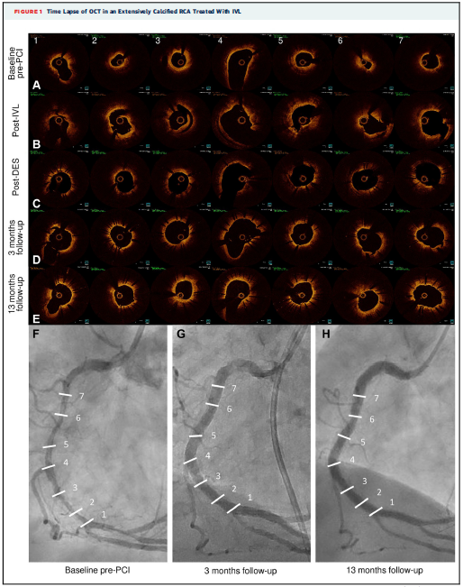 ShockwaveIVL's tweet photo. Ever wonder what happens long-term to the transmural cracks following #ShockwaveIVL? You gotta see it to believe it. Check out an #OCT visualization of IVL’s healing process over 1 year by Dr @ziadalinyc et al in @JACCJournals: https://t.co/PeDc2JwQyC

ISI https://t.co/sZ0NdzXNcV https://t.co/5nJD3zS05g