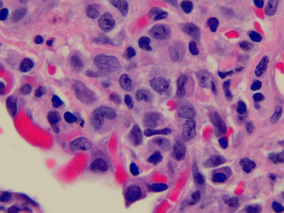 smlungpathguy's tweet photo. Langerhans cells in pulmonary Langerhans cell histiocytosis (high mag, H&amp;E): Oil immersion.  https://t.co/wgBuNvqWTw https://t.co/p1T8BrRRVJ