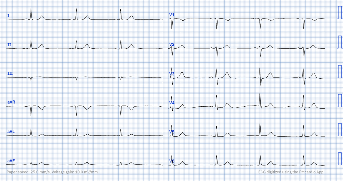 72F w/ chest pain. What's the pattern?

#CardioTwitter #ECG #FOAMed