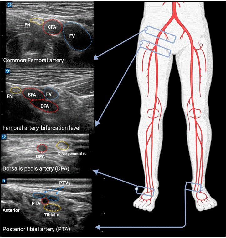 “Ultrasound-guided arterial catheterisation.” @ACEP_EUS #FOAMcc #EMCCM #FOAMed #VascularAccess #MedEd #UltrasoundGuidedVascularAccess #POCUS Press “Alt” for image descriptions 

🔗 anesth-pain-med.org/m/journal/view…