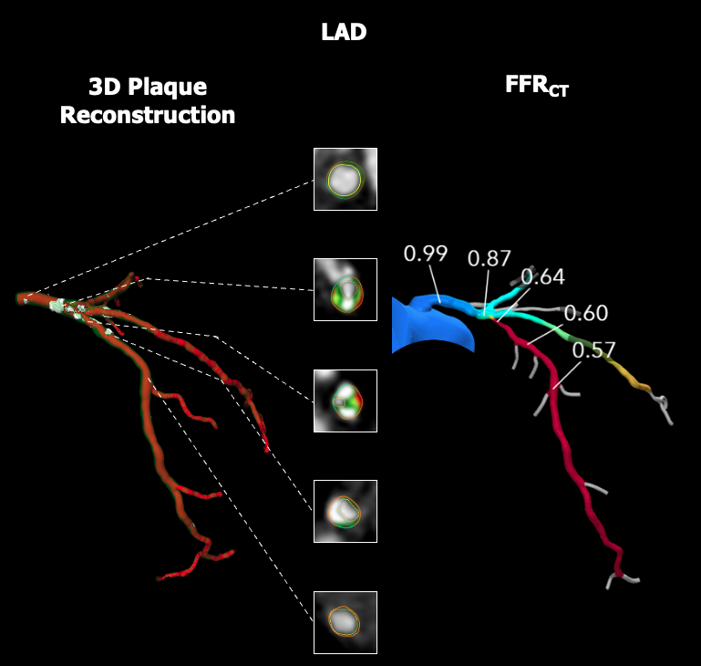 ColletCarlos's tweet photo. PCI Planning of a Left Main Trifurcation in the #P4 trial

🚩Large  mass subtended by the ramus
🔗 7Fr radial with 3 wires 
🧯 No disease in the ostial Circ or ramus 
🦴 Thick calcium in the left main 
🛬 no landing zone in the LAD

@heartflow Planner predicts Post-PCI FFR 0.80 https://t.co/C58INonmgD
