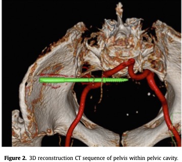 ArthroToday's tweet photo. No free lunch! This case report describes loss of a pelvic array pin during navigated THA, requiring retrieval via laparotomy. #orthotwitter @ZubinHalifax @marcusmilderman @mattbarbermd @MortezaMeftahMD 

https://t.co/yl3fxfOH0o https://t.co/dczU4GoMsp