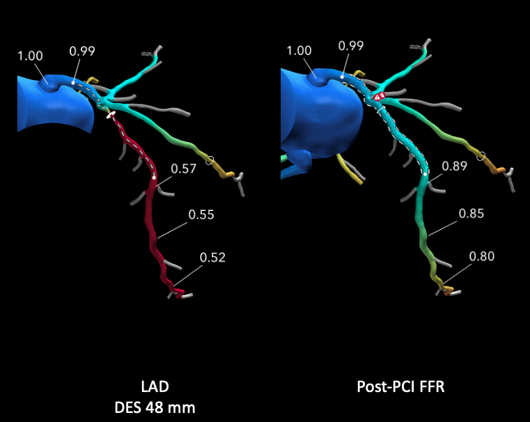 ColletCarlos's tweet photo. PCI Planning of a Left Main Trifurcation in the #P4 trial

🚩Large  mass subtended by the ramus
🔗 7Fr radial with 3 wires 
🧯 No disease in the ostial Circ or ramus 
🦴 Thick calcium in the left main 
🛬 no landing zone in the LAD

@heartflow Planner predicts Post-PCI FFR 0.80 https://t.co/C58INonmgD