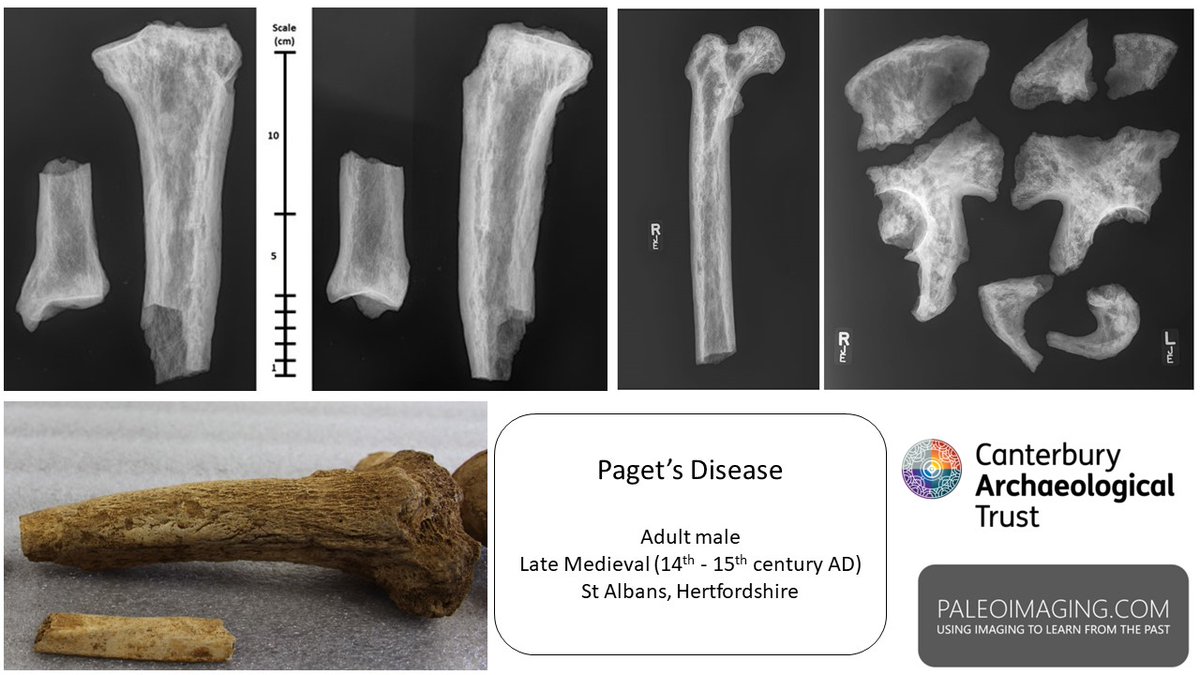 Happy to announce a new open access article about Paget's Disease in a late Medieval individual from St Albans. doi.org/10.1016/j.fri.… The study links this condition with forensic science as a criteria for biological profiling. @CantArchTrust @CCCUarchaeology @sotonarch