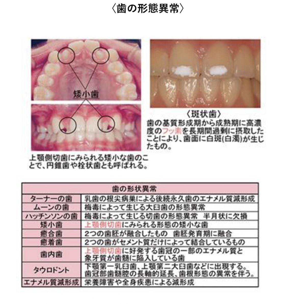 歯科のための一問一答 on X: 【歯の形態異常】まとめ t.coCRgRn1XWIZ  X
