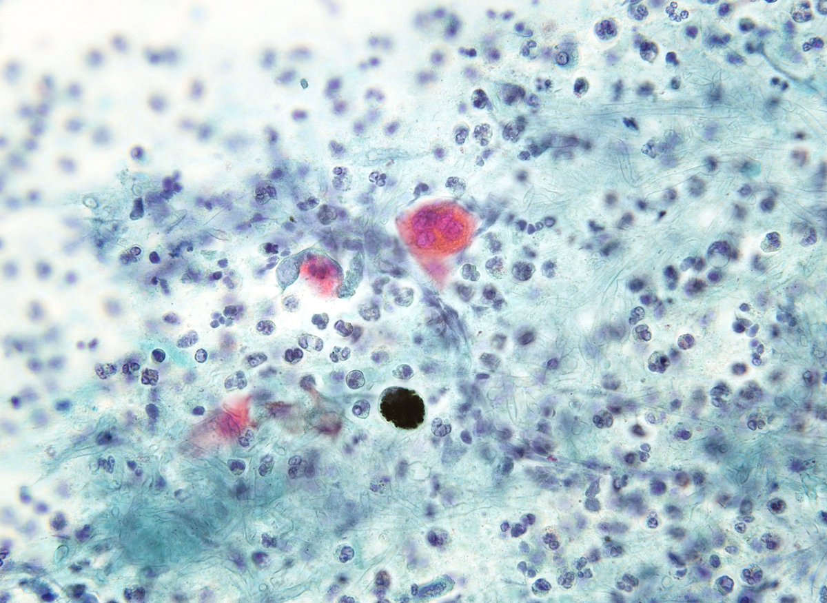 sza_jhcyto's tweet photo. ASPERGILLOMA, in the lung is a rare but an extremely serious dx pitfall as it mimics Squamous Cell CA clinically, radiologically and cytopathologically (mass forming lesion with cystic necrosis and atypical keratinized squamous cells). A great example seen this week. (FNA) https://t.co/tuhbxqGA6Q