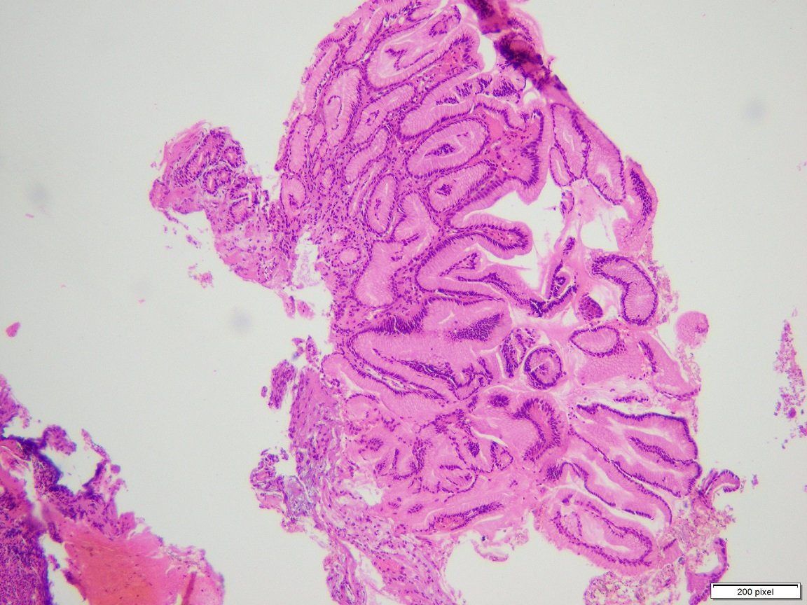 ChughtaiPathRes's tweet photo. Clostridium ventriculi (formally called Sarcina) 
🍀 Classic "Tetrad" like organisms seen in this gastric biopsy 
#PathTwitter #microbiology https://t.co/zN0y6Wjf5J
