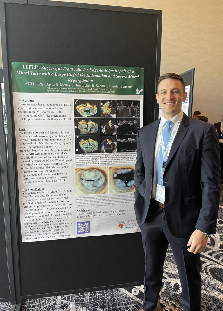 BradMoney6's tweet photo. Exciting times @miamivalves !  

Presented a case showing successful TEER in patient with cleft-like indentation of posterior MV leaflet &amp; improvement of NYHA class IV symptoms @cscomaMD 

➡️ Also, a lot of buzz regarding anticipated data for TAVR in asymptomatic moderate AS https://t.co/XxAIDm2uto