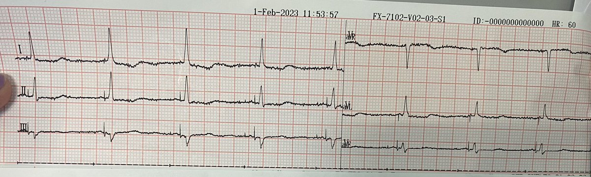 ECG pre y post estimulación del Haz de his en paciente con MCD y BCRI <a href="/manorobaina/">Maria Noel Robaina</a> @Pompastockolmo @Dr Luis Vidal Centro Cardiologico Americano