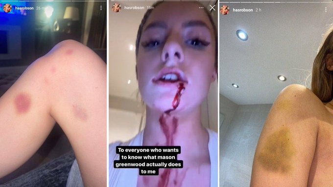 I’ve seen the pictures and heard the recording. The CPS dropping the charges against Mason Greenwood doesn’t mean he’s innocent. 

It’s just further evidence that our so called justice system exists to protects rapists and abusers and constantly, horrifically fails women.