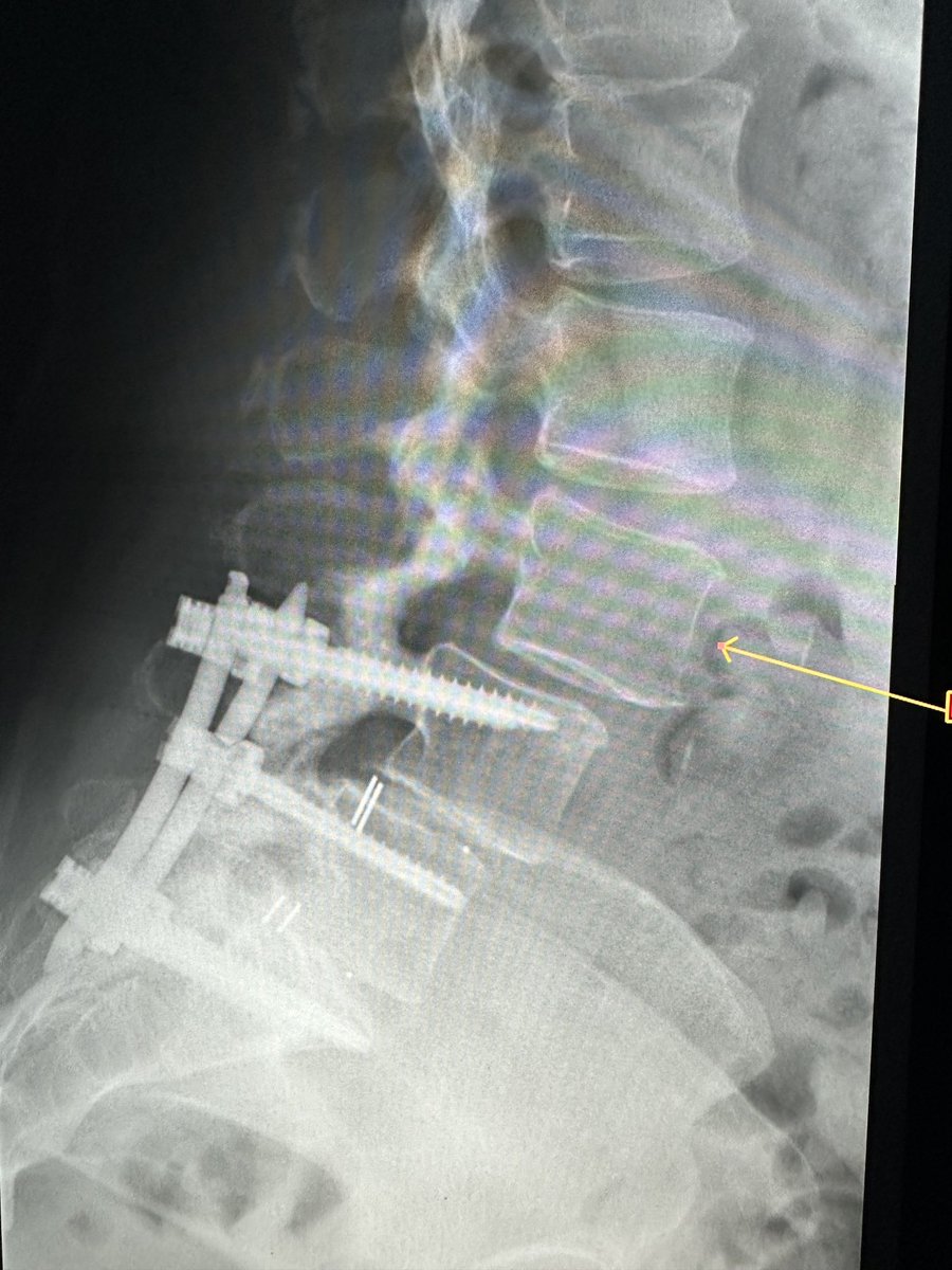 Same day. The supine MRI vs The upright radiographs. neutral position. patient standing
