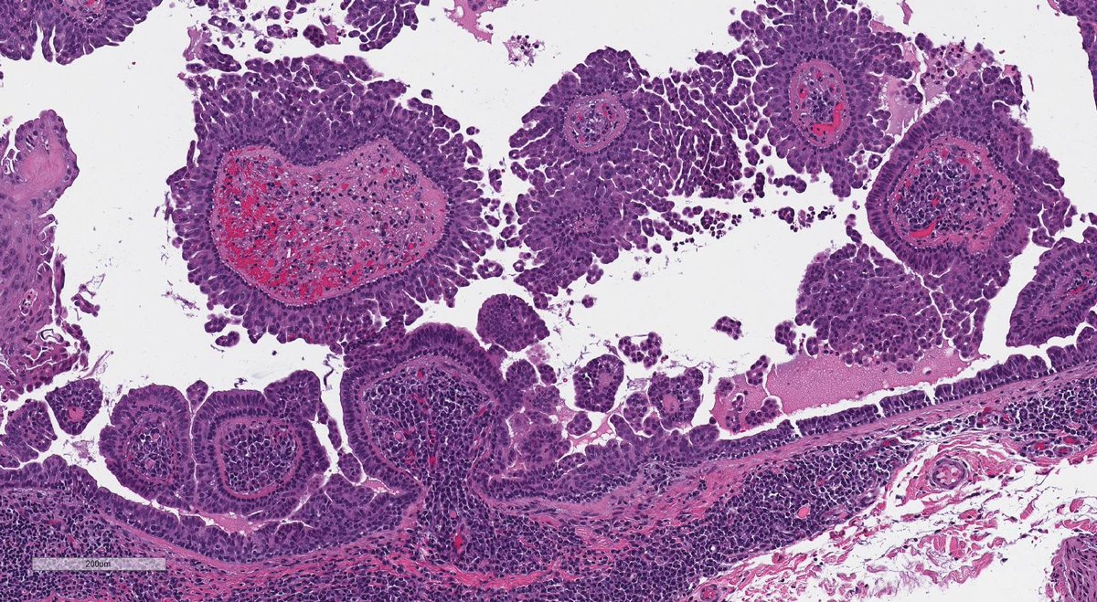 Adult, neck lesion. Love an entity with a looooong name. 😁 #dermpath #pathology #dermatology #dermtwitter
