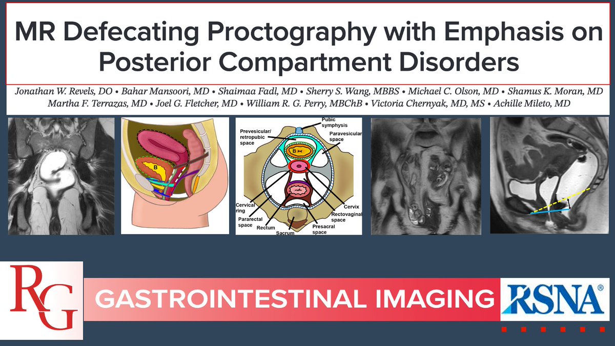 MR defecating proctography is a powerful tool for dynamic evaluation of the pelvis & assessment of defecation. Let’s get to the bottom of this to learn basic concepts, techniques, & posterior compartment pathology! 
bit.ly/3Cy2qij 👉 @JRevRad1 et al
@cookyscan1 
#RGphx