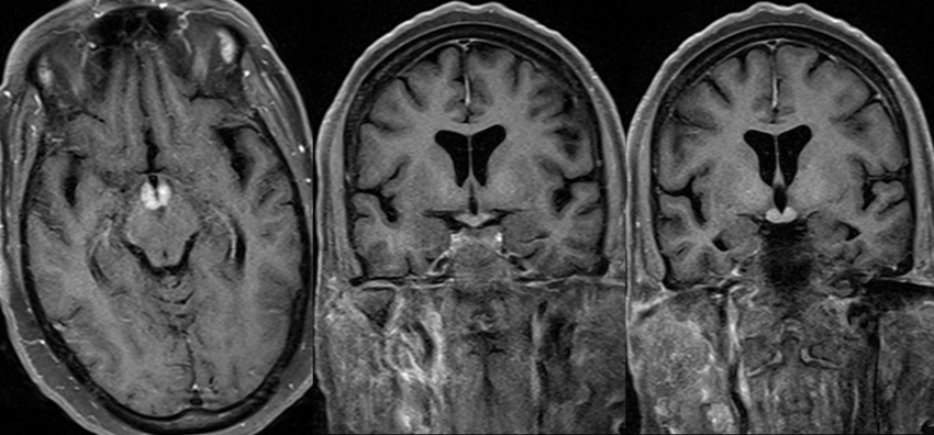 DRY JANUARY QUIZ ! 1/5
🇬🇧 54 yo male, alcohol : 90g/d, is admitted w/ diplopia + ataxia + confusion. Likeliest diagnosis and diagnostic test ?
🇫🇷 Homme 54a, alcool : 90g/j , admis pr diplopie + ataxie + confusion. Diag probable + examen pr confirmer ?
#NeuroQuiz n°3
#neurotwitter