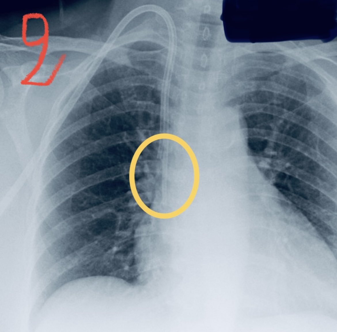 Which tip of Tunneled Dialysis Catheter is in correct position 1 or 2? #nephrologytwitter @Medtwitteer @CriticalCareRN_ @RadiologySigns @RadiologyACR
