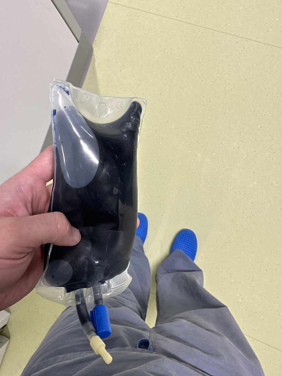 Brian Brenner (@brianbrennermd) on Twitter photo <a href="/msenussiMD/">Mourad H Senussi, MD, MS</a> In the OR often when patients have profound vasoplegia from multiple runs of #CPB it can be a life sustaining medication to get them through the acute physiologic exhaustion until their endothelial stores of ca2+ and other ions etc can recover. Also matches 👞 <a href="/msenussiMD/">Mourad H Senussi, MD, MS</a> In the OR often when patients have profound vasoplegia from multiple runs of #CPB it can be a life sustaining medication to get them through the acute physiologic exhaustion until their endothelial stores of ca2+ and other ions etc can recover. Also matches 👞