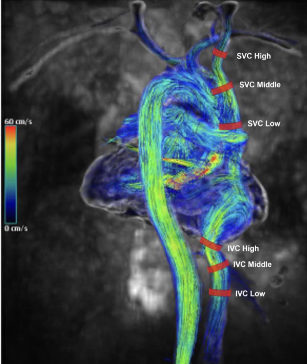 Delighted to attend #SCMR23 and show our results on vena cava blood flow quantified by #4Dflow in patients with pulmonary hypertension.

@bdallen6 @JackCerne @JamesCCarrMD @NURadiology 

#radiology #CMR #northwestern #cvteam