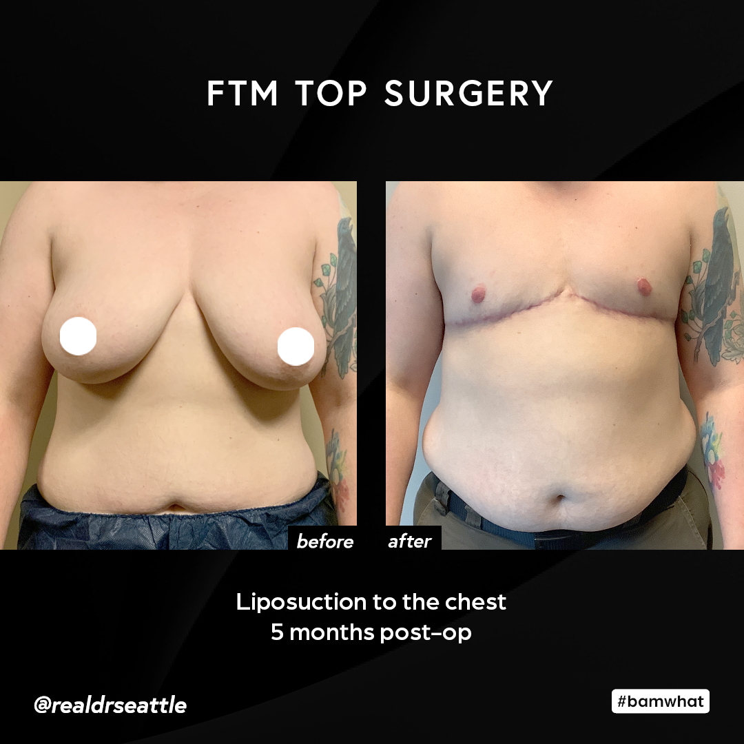 realdrseattle's tweet photo. Dr. Sajan doesn't just perform top surgery, he sculpts the chest! 🙌🏾
#realdrseattle #allureesthetic #topsurgery #ftmtopsurgery #ftmchest #trans #ftm #ftmtransgender #transman #transgender #transgendermale #genderaffirmingsurgery #transgendersurgery #transgendertopsurgery https://t.co/OnFaXjW7R9