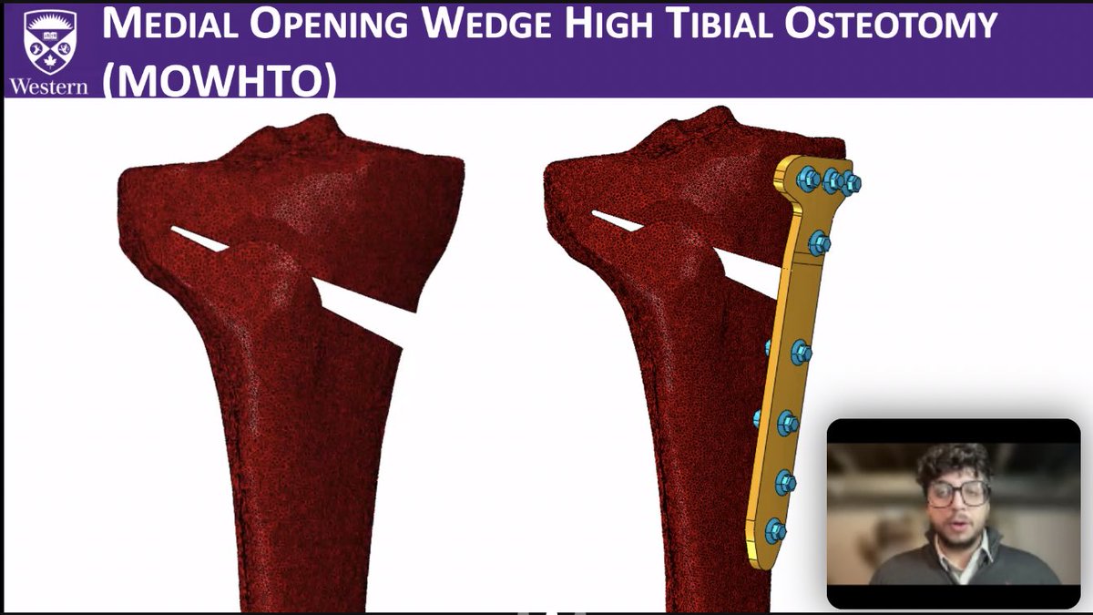 🎉 Victor Carranza, MESc !! 🎉
Big congratulations to Victor who defended his masters thesis yesterday, showcasing his work on the effect of rotating the hinge axis on the posterior tibial slope during MOWHTO!