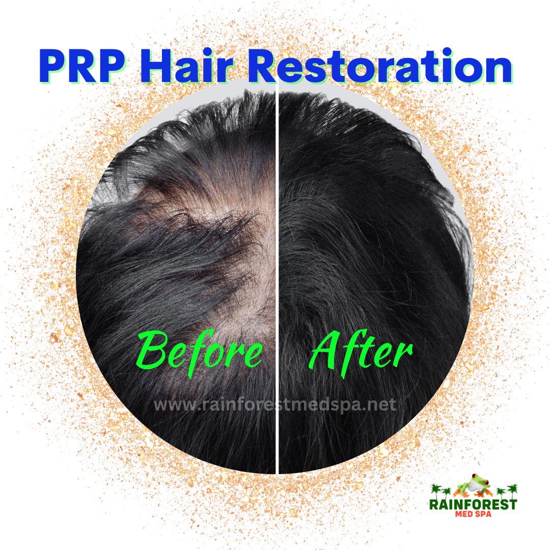 PRP (platelet-rich plasma) therapy for hair loss is a medical treatment in which a person’s blood is drawn, processed, and then injected into the scalp.👍
☎ 516-900-7772
💻 rainforestmedspa.net

#rainforestmedspa
#botox
#fillers
#prp 
#prphairrestoration 
#hairloss 
#prphair