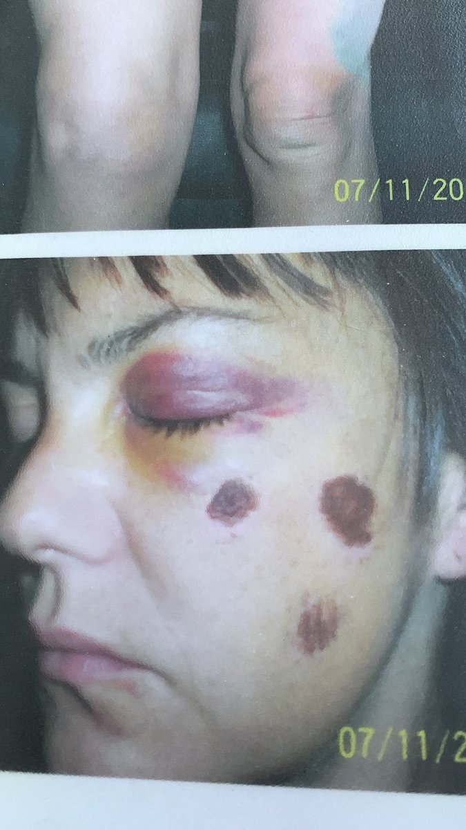DesignzMaxines's tweet photo. @RishiSunak Police brutality has been hidden for years. This is what one policeman on a Friday night did to me but the police photos taken by the police went ‘missing’ but I took my own https://t.co/vBKvouH6bj