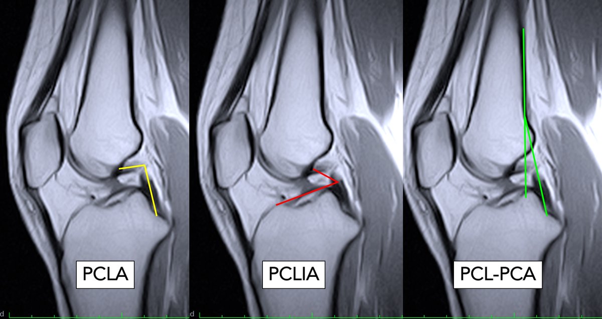 drjaimepalos's tweet photo. Very useful!
In this case (chronic): A bad quality MRI, where the ACL "does not appear injured in any cut", to demonstrate (by imaging) that the patients needs surgery. 
Arthroscopic finding attached. 
#ACL #arthroscopy #sportsmedicine https://t.co/VgYHIWX9Kj