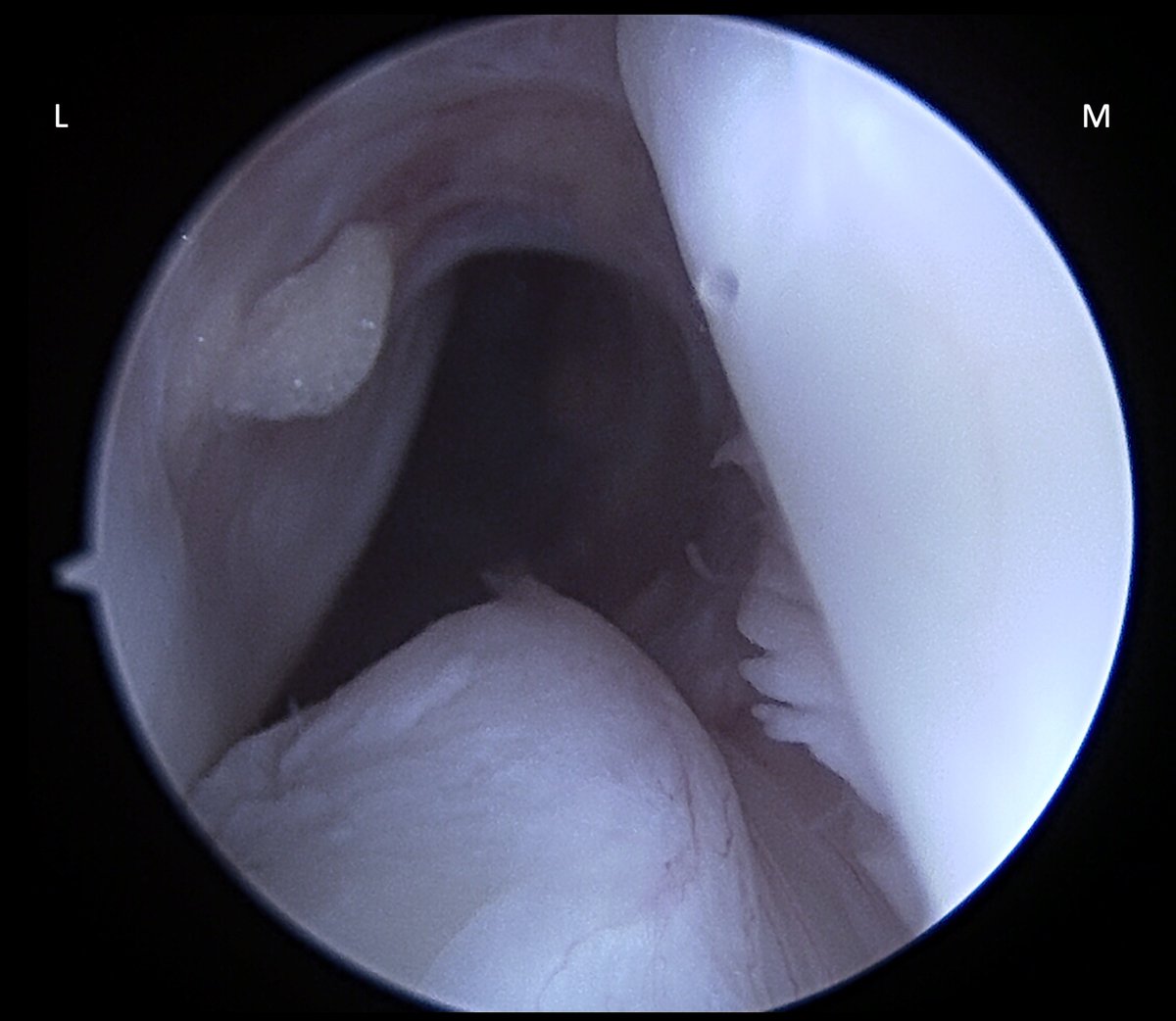 Very useful!
In this case (chronic): A bad quality MRI, where the ACL "does not appear injured in any cut", to demonstrate (by imaging) that the patients needs surgery. 
Arthroscopic finding attached. 
#ACL #arthroscopy #sportsmedicine
