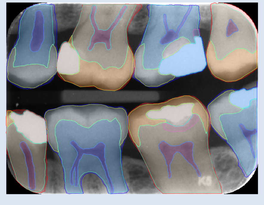 CoTreatAI's tweet photo. We're learning to see like a dentist using computer vision. Our tooth parts detection model will one day be the cornerstone of understanding the precise severity of observations like caries, alveolar bone loss and surface area lost to direct restorations. https://t.co/AI3XuemXMw