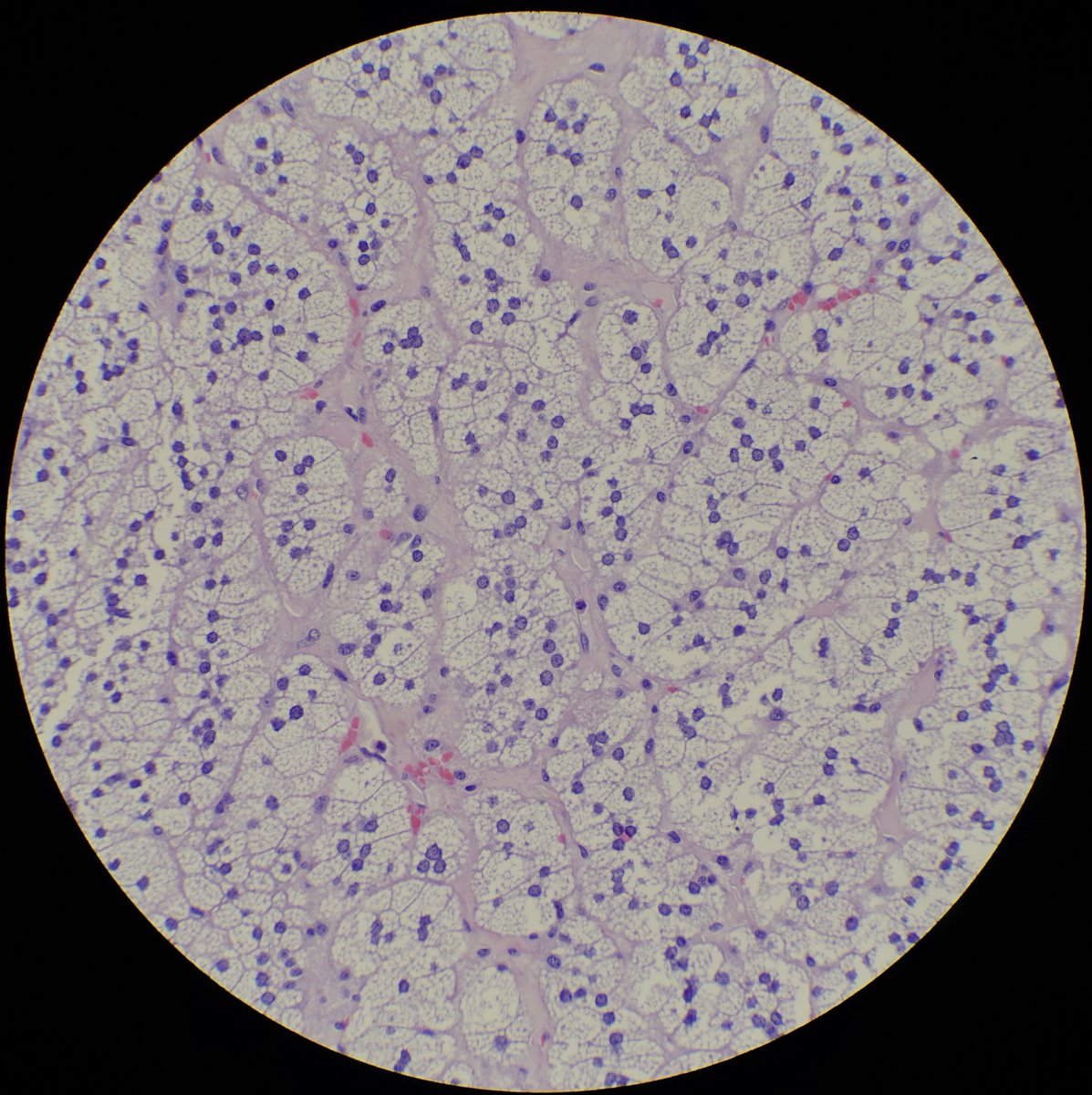 These 2 abdominal tumors came today.  They have similar architecture but different cytologic features. Which is the bad and which is the Ugly?   #PathTwitter #pathart #GuPath #surgpath